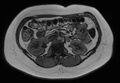 Normal liver MRI with Gadolinium (Radiopaedia 58913-66163 B 11).jpg