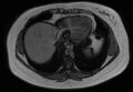 Normal liver MRI with Gadolinium (Radiopaedia 58913-66163 B 29).jpg