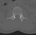 Normal lumbar spine CT (Radiopaedia 46533-50986 Axial bone window 22).png