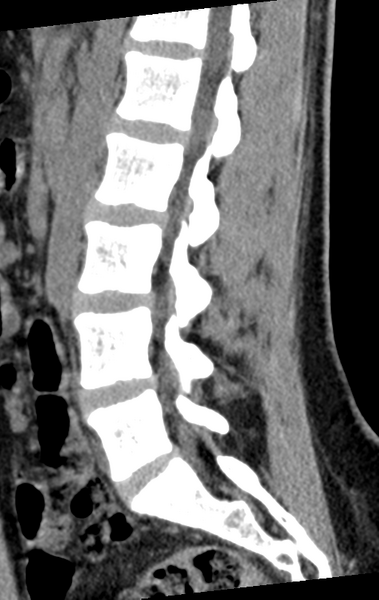 File:Normal lumbar spine CT (Radiopaedia 46533-50986 C 46).png