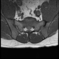 Normal lumbar spine MRI (Radiopaedia 35543-37039 Axial T1 3).png