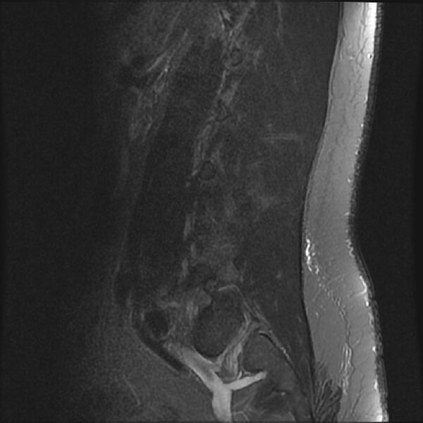 File:Normal lumbar spine MRI (Radiopaedia 43051-46311 Sagittal STIR 4).jpg