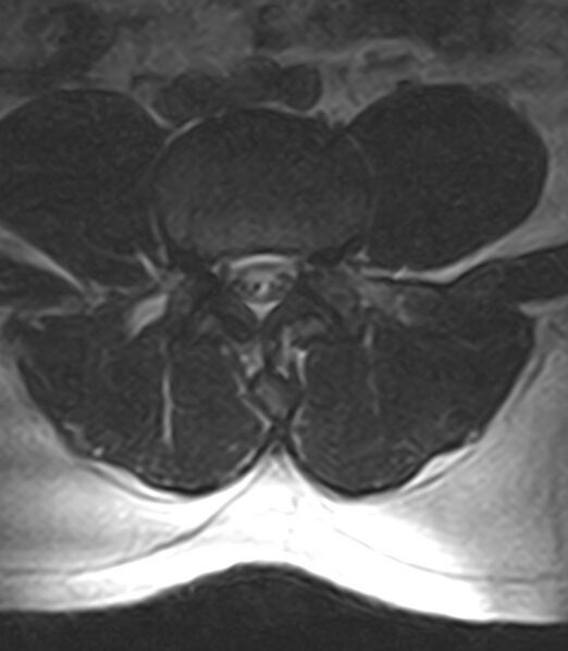 File:Normal lumbar spine MRI - low-field MRI scanner (Radiopaedia 40976-43699 Axial T2 65).jpg