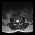 Normal spine MRI (Radiopaedia 77323-89408 Axial T2 4).jpg