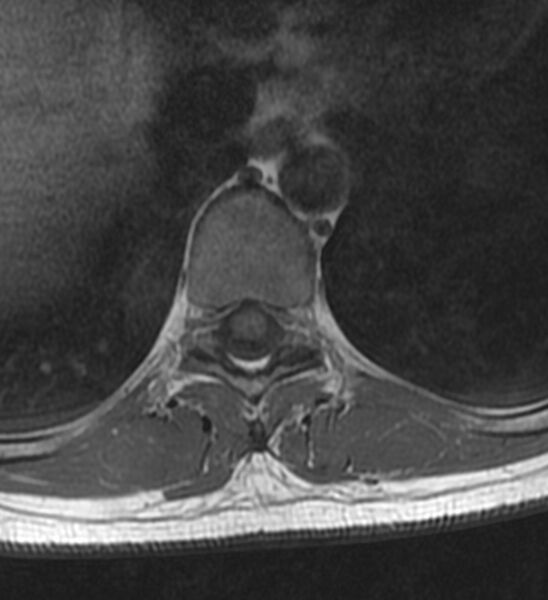 File:Normal thoracic spine MRI (Radiopaedia 41033-43781 Axial T1 12).jpg