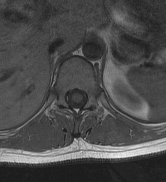 File:Normal thoracic spine MRI (Radiopaedia 41033-43781 Axial T1 21).jpg