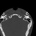 Occipital condyle fracture (Radiopaedia 31755-32691 Axial bone window 1).jpg