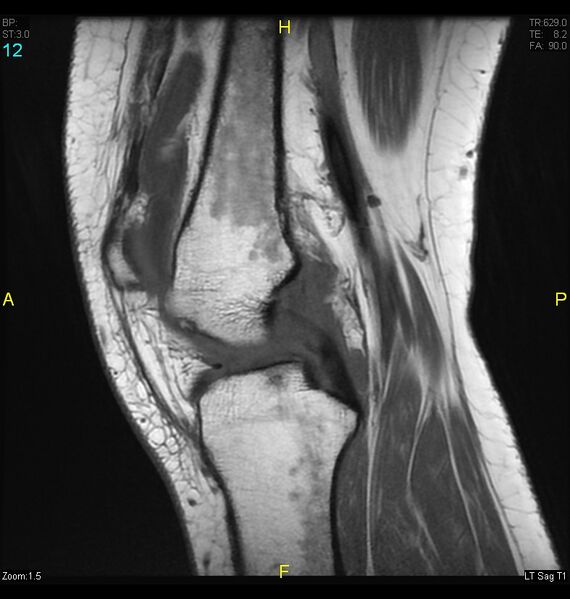 File:ACL mucoid degeration with cystic changes (Radiopaedia 48428-53341 Sagittal T1 10).jpg