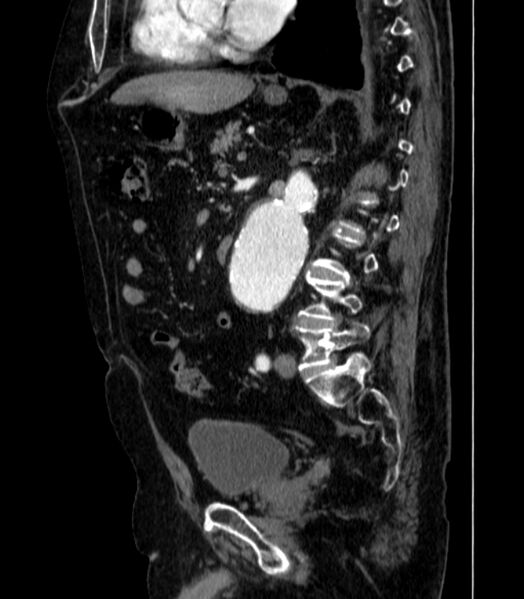 File:Abdominal aortic aneurysm (Radiopaedia 25855-26001 Sagittal C+ arterial phase 35).jpg
