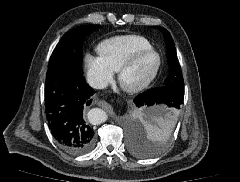 File:Abdominal aortic aneurysm rupture (Radiopaedia 54179-60362 Axial C+ portal venous phase 37).jpg
