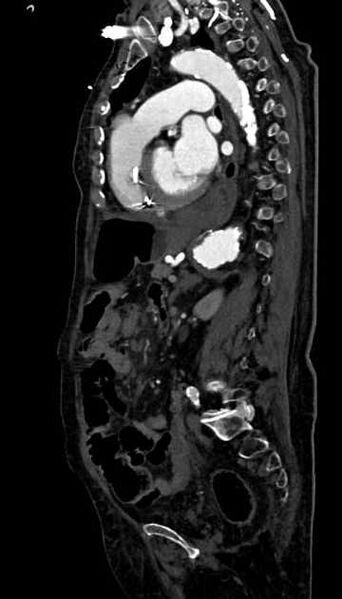 File:Abdominal aortic aneurysm with thrombus fissuration (Radiopaedia 73192-83919 Sagittal C+ arterial phase 54).jpg
