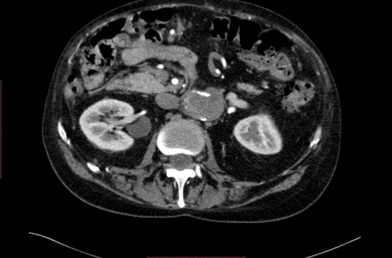 File:Abdominal aortic interposition tube graft and aneurysm thrombosis (Radiopaedia 71438-81857 Axial C+ arterial phase 53).jpg