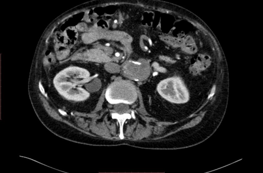 Abdominal aortic interposition tube graft and aneurysm thrombosis (Radiopaedia 71438-81857 Axial C+ arterial phase 53).jpg