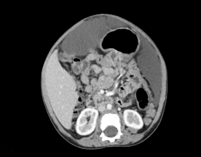 File:Abdominal premesenteric cystic lymphangioma (Radiopaedia 82995-97350 Axial C+ portal venous phase 28).jpg