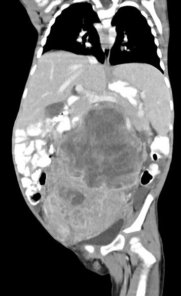 File:Abdominopelvic rhabdomyosarcoma (Radiopaedia 78356-90984 Coronal C+ portal venous phase 50).jpg