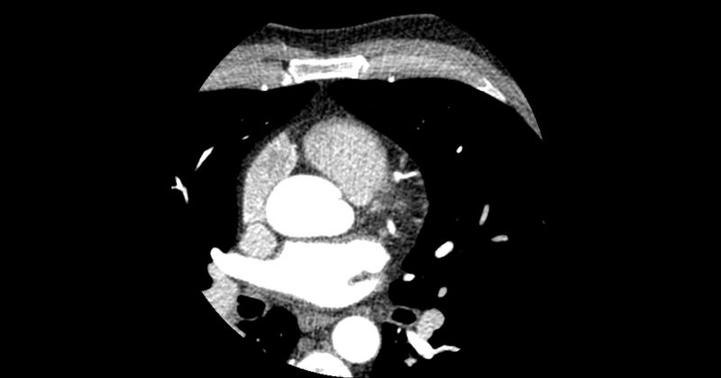File:Aberrant left main coronary artery (ALMCA) arising from the right sinus with interarterial course (Radiopaedia 63251-71814 Axial C+ arterial phase 57).JPG
