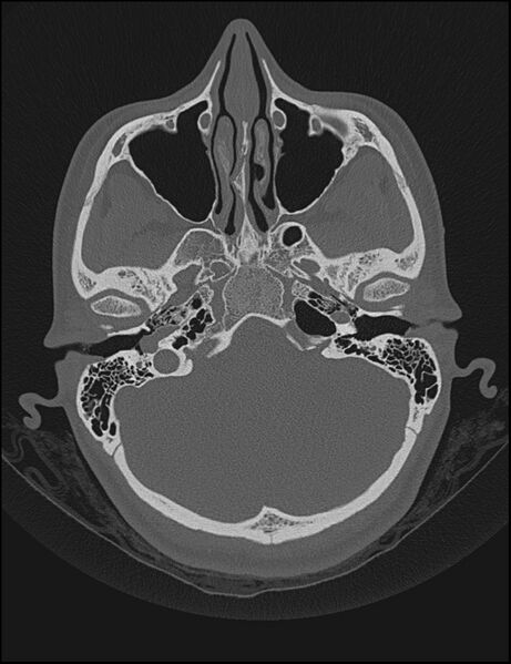 File:Aberrant right internal carotid artery (Radiopaedia 65191-74198 Axial non-contrast 35).jpg