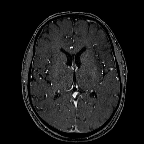 File:Accessory middle cerebral artery (Radiopaedia 73114-83828 Axial MRA 111).jpg