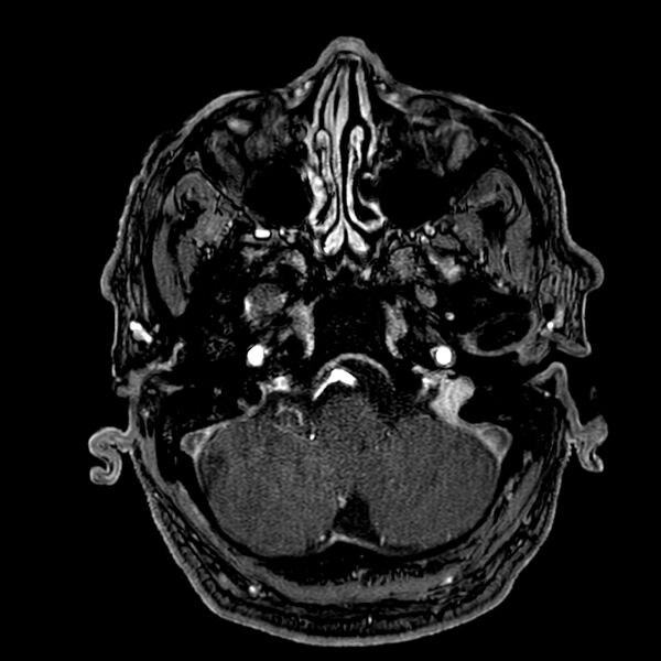 File:Accessory middle cerebral artery (Radiopaedia 73114-83828 Axial MRA 22).jpg