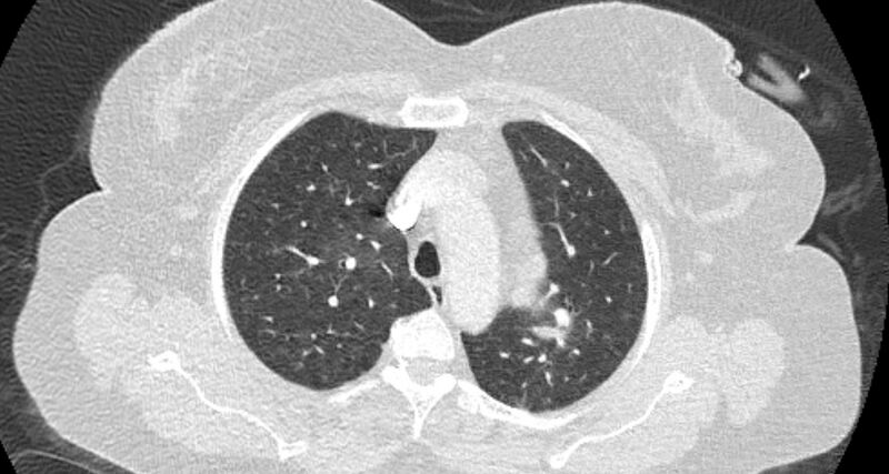 File:Accessory right inferior hepatic vein (Radiopaedia 65245-74259 Axial lung window 14).jpg