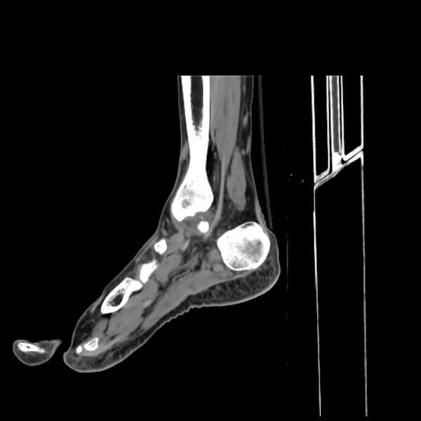 File:Accessory soleus muscle (Radiopaedia 61069-68943 C 31).jpg