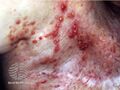 Acquired lymphangiectasia (DermNet NZ doctors-lesions-images-lymphangiectasia1).jpg