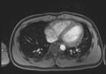 Active right ventricular cardiac sarcoidosis (Radiopaedia 55596-62100 Axial Post contrast Dixon 52).jpg