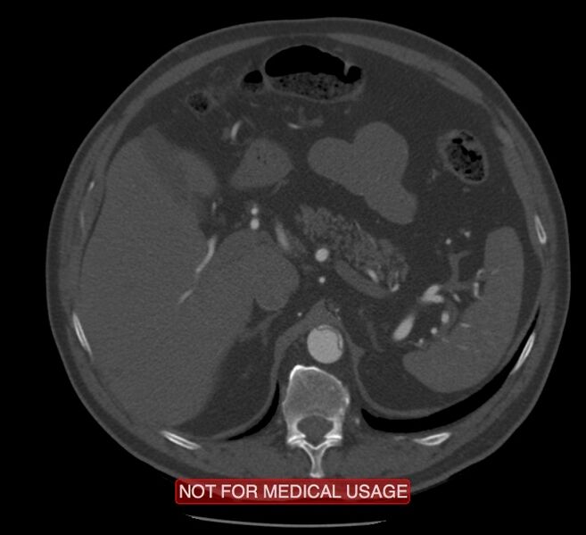 File:Acute aortic dissection - Stanford type A (Radiopaedia 40661-43285 Axial C+ arterial phase 85).jpg