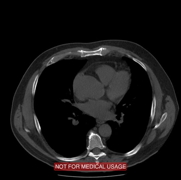 File:Acute aortic dissection - Stanford type A (Radiopaedia 40661-43285 Axial non-contrast 33).jpg
