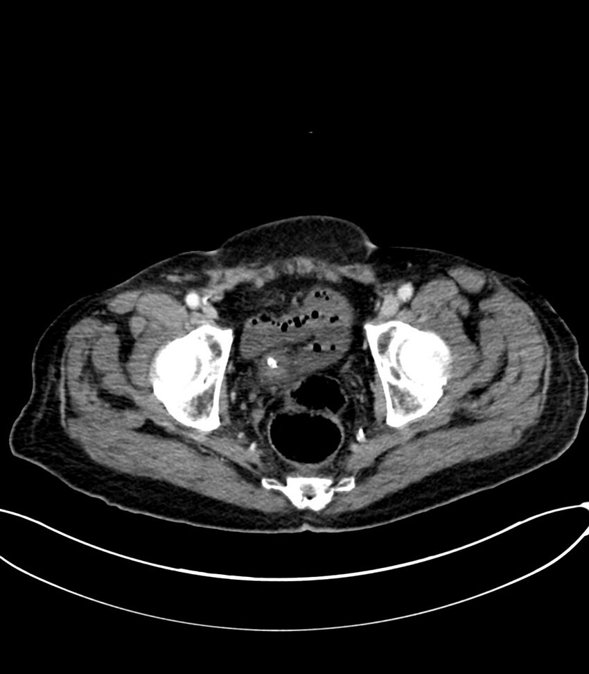 Acute arterial mesenteric ischemia (Radiopaedia 78238-90828 Axial C+ portal venous phase 129).jpg