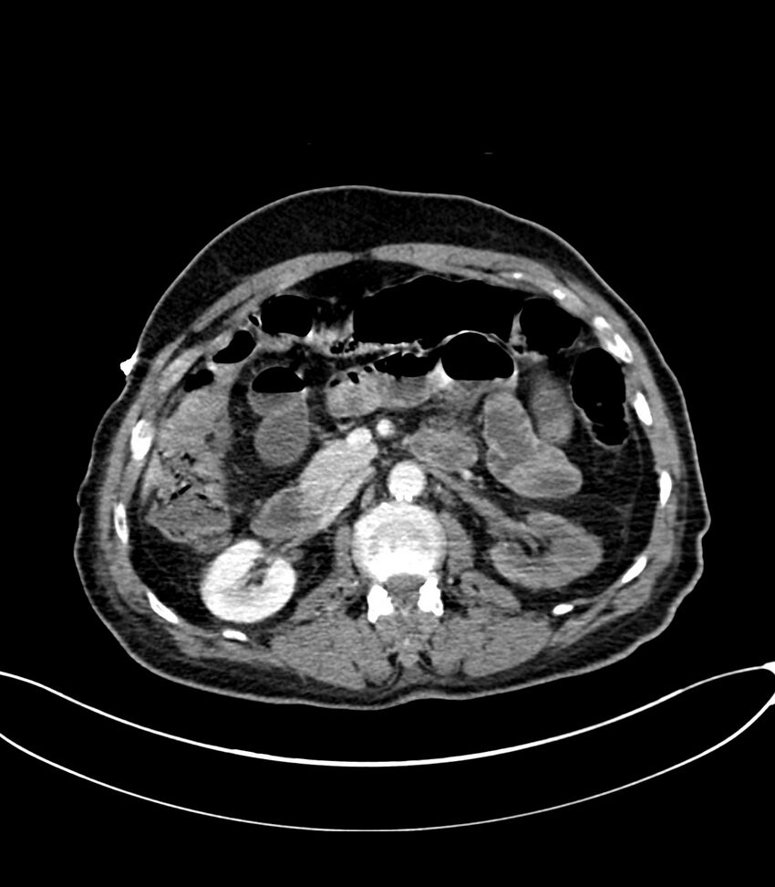 Acute arterial mesenteric ischemia (Radiopaedia 78238-90828 Axial C+ portal venous phase 56).jpg