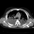 Acute aspiration pneumonitis (Radiopaedia 33605-34703 Axial non-contrast 38).jpg