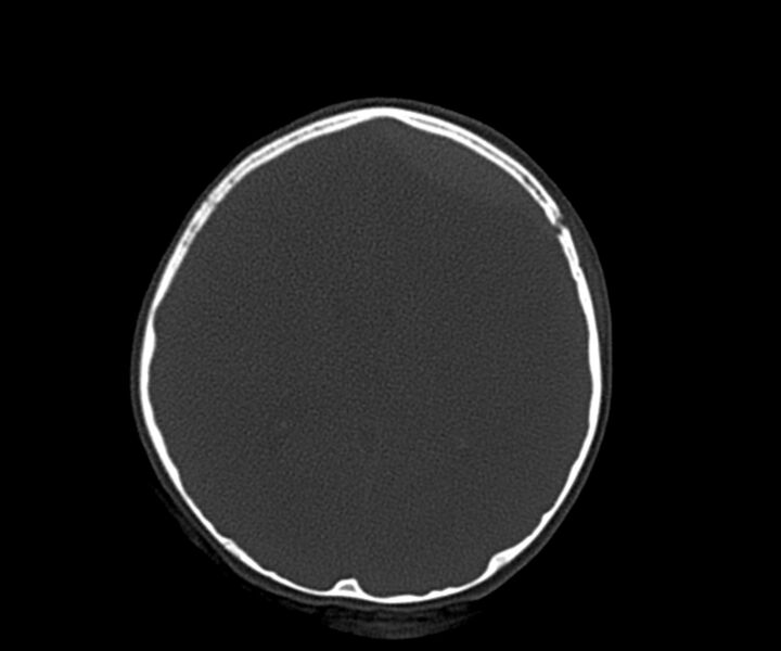 File:Acute epidural hematoma (Radiopaedia 63659-72335 Axial bone window 19).jpg