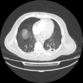Acute heart failure (CT) (Radiopaedia 79835-93075 Axial lung window 31).png