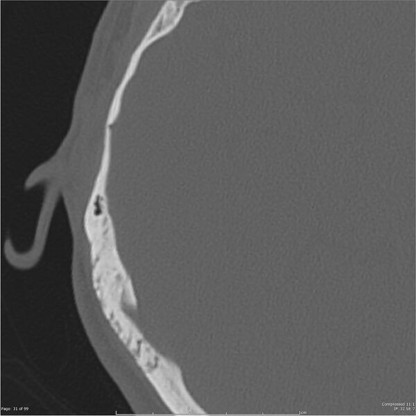 File:Acute otomastoiditis (Radiopaedia 28276-28512 Axial PTB bone window reformat 11).jpg