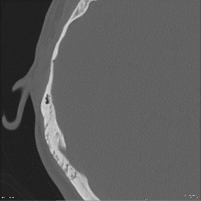 Acute otomastoiditis (Radiopaedia 28276-28512 Axial PTB bone window reformat 11).jpg