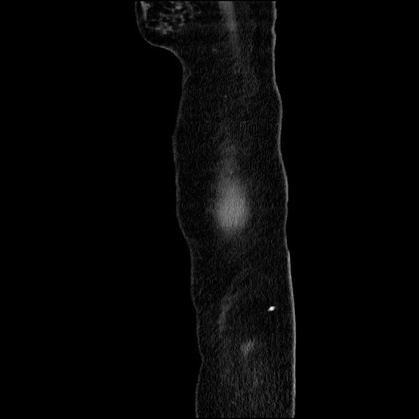 File:Acute pancreatitis (Radiopaedia 69236-79012 Sagittal C+ portal venous phase 92).jpg