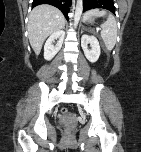 File:Acute pancreatitis - Balthazar E (Radiopaedia 29016-29377 Coronal C+ portal venous phase 63).png
