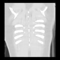 Acute pulmonary edema on CT (Radiopaedia 33582-34672 Coronal lung window 36).jpg