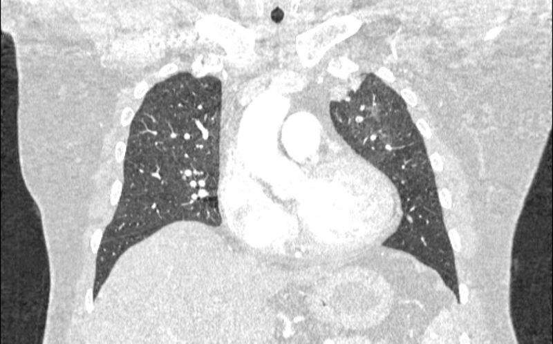 File:Acute pulmonary embolism with pulmonary infarcts (Radiopaedia 77688-89908 Coronal lung window 30).jpg