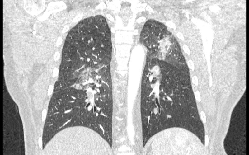 File:Acute pulmonary embolism with pulmonary infarcts (Radiopaedia 77688-89908 Coronal lung window 69).jpg