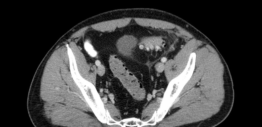 Acute sigmoid colon diverticulitis (Radiopaedia 55507-61976 Axial C+ portal venous phase 91).jpg