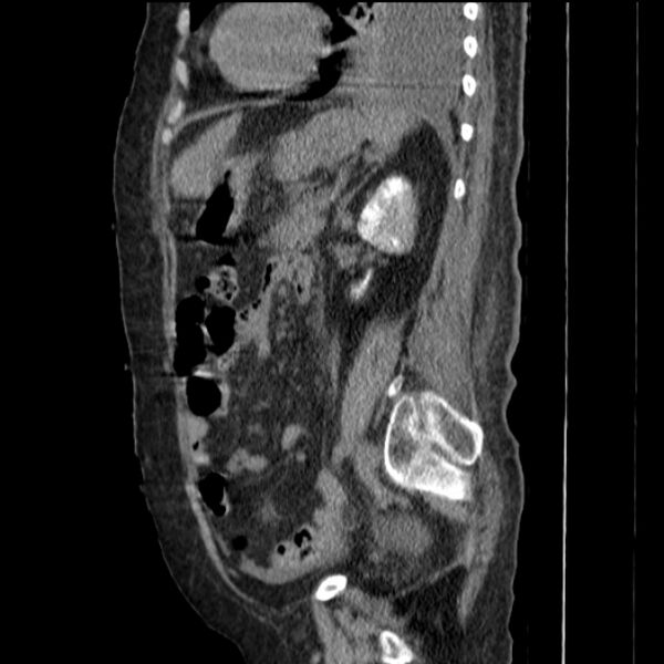 File:Acute tubular necrosis (Radiopaedia 28077-28334 H 58).jpg