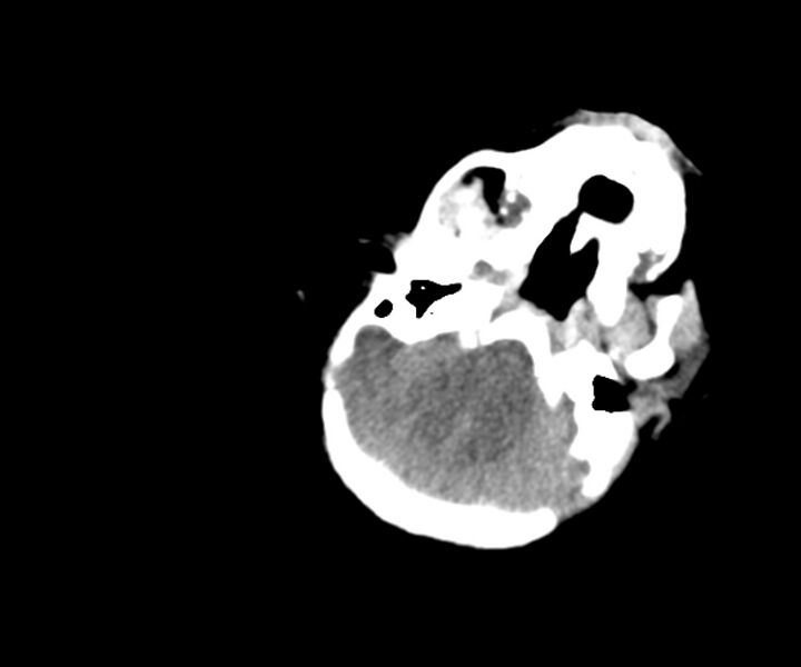 File:Acute ventriculitis (Radiopaedia 57502-64459 Axial non-contrast 4).jpg