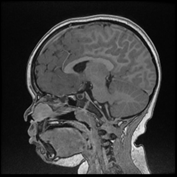 File:Adamantinomatous craniopharyngioma (Radiopaedia 77407-89529 Sagittal T1 C+ 62).jpg
