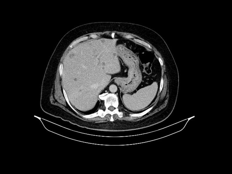 File:Adenocarcinoma of pancreas with hepatic metastasis (Radiopaedia 64332-73122 Axial C+ delayed 22).jpg