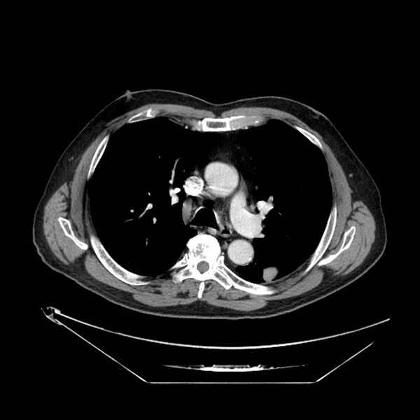 File:Adenocarcinoma of the lung (Radiopaedia 44876-48759 Axial C+ portal venous phase 34).jpg
