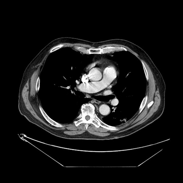 File:Adenocarcinoma of the lung (Radiopaedia 44876-48759 Axial C+ portal venous phase 41).jpg
