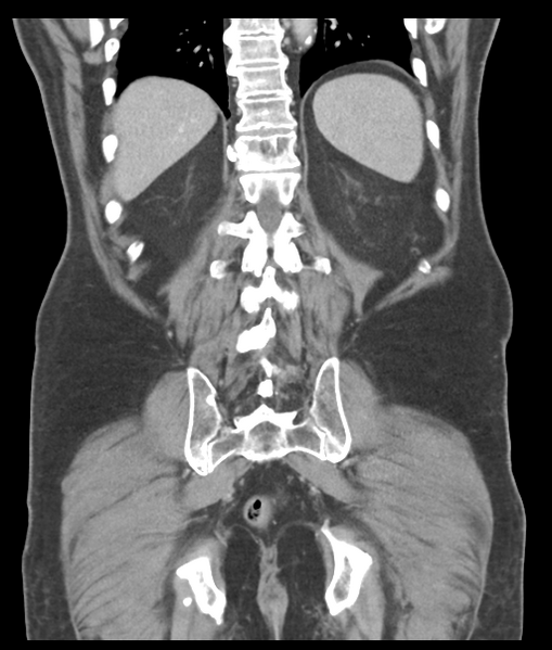 File:Adenocarcioma of rectum- T1 lesion (Radiopaedia 36921-38547 Coronal C+ portal venous phase 49).png