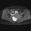 Adenomyosis and endometriotic cysts (Radiopaedia 82300-96367 Axial T1 C+ fat sat 15).jpg